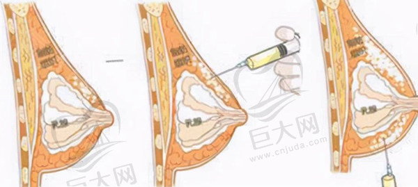 我做自体脂肪丰胸后悔了