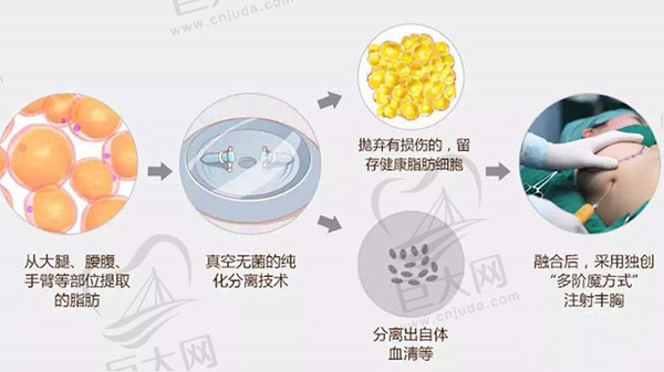 做过自体脂肪丰胸的姐妹说下感受