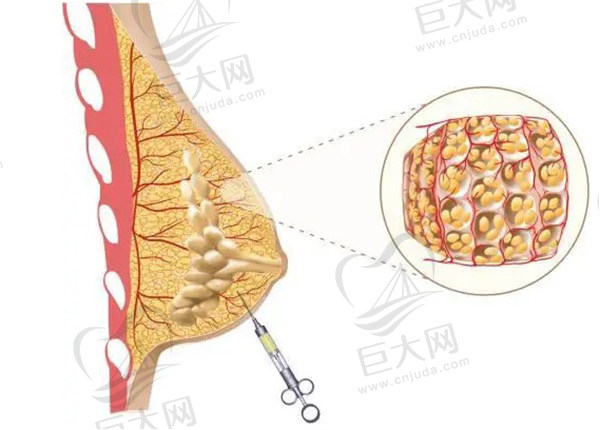 做过自体脂肪丰胸的姐妹说下感受