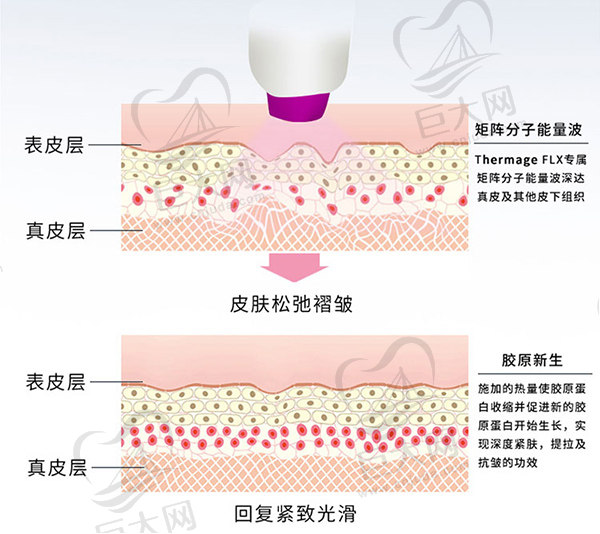 热玛吉