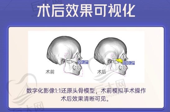 重庆华美整形外科医院下颌角技术优势