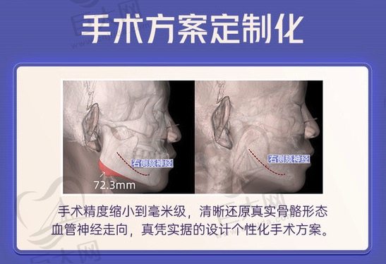 重庆华美整形外科医院下颌角技术优势