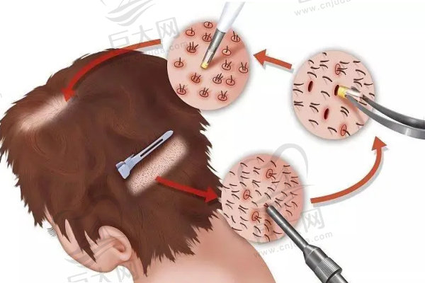 微针植发技术