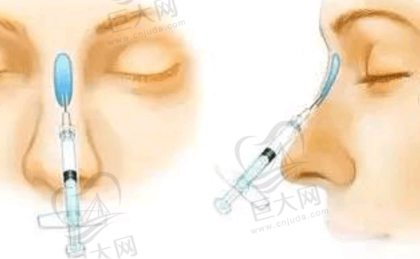 玻尿酸注射隆鼻方式