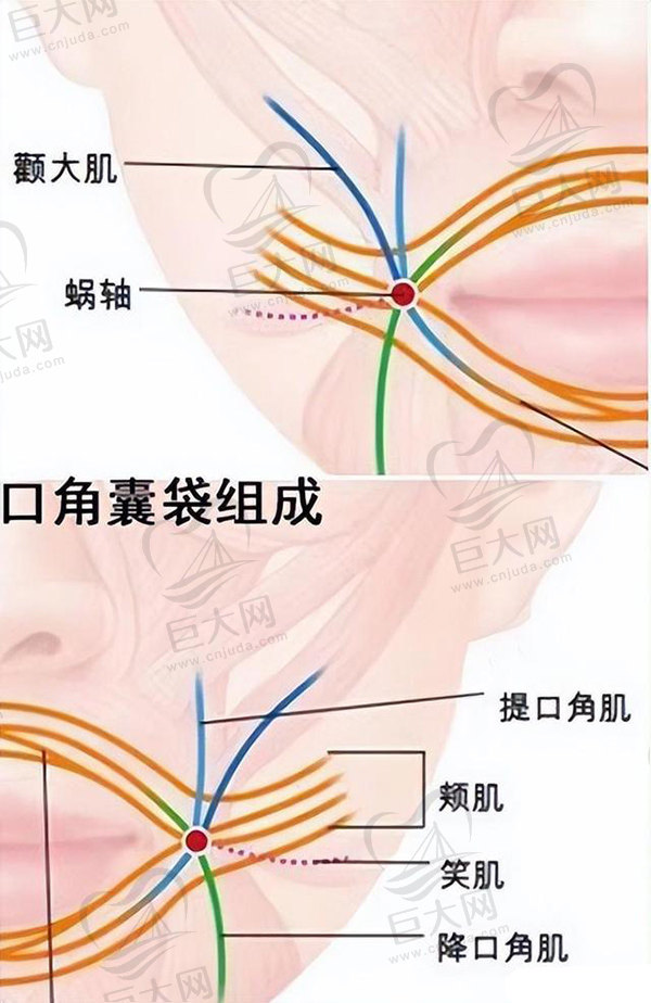 面部口角囊袋-线提升
