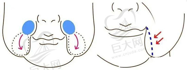 面部口角囊袋-拉皮手术