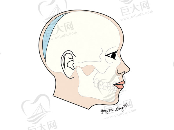 重庆松山（原宽仁）整形医院珊瑚骨后脑勺填充