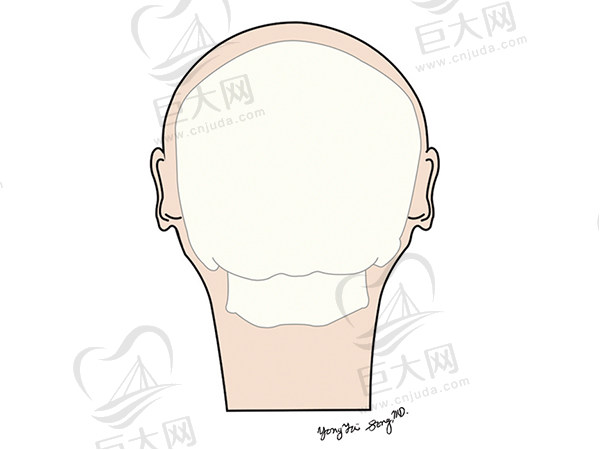 内后脑勺骨水泥填充手术优势