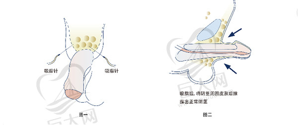 吸脂阴茎延长术