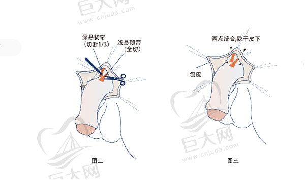 隐痕阴茎延长术