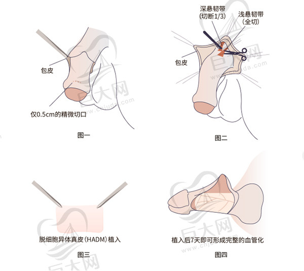 隐痕阴茎延长增粗术