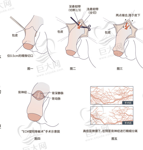 隐痕双延长术