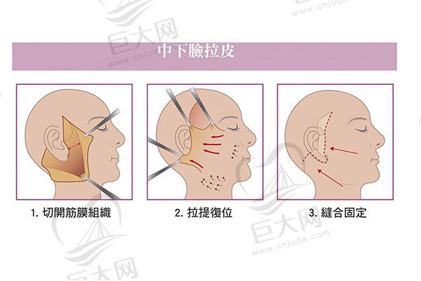 拉皮手术