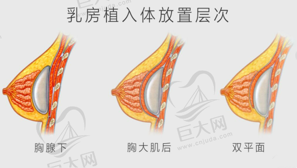 乳房植入体放置层次