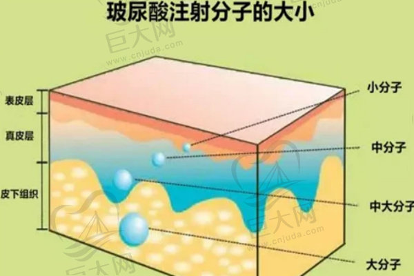 玻尿酸注射分子大小的区别