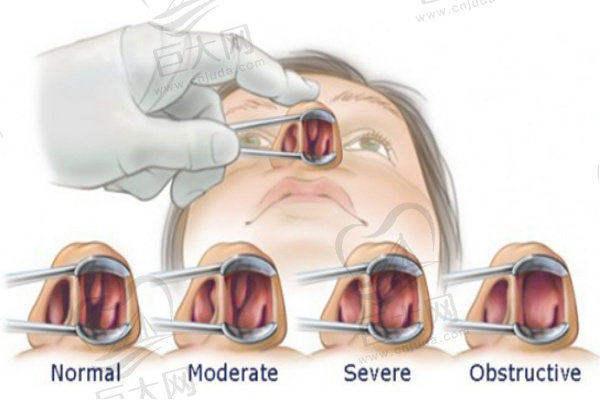 鼻中隔偏曲矫正手术