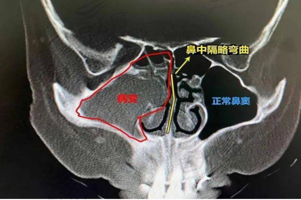 鼻中隔偏曲影像图