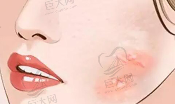 疤痕