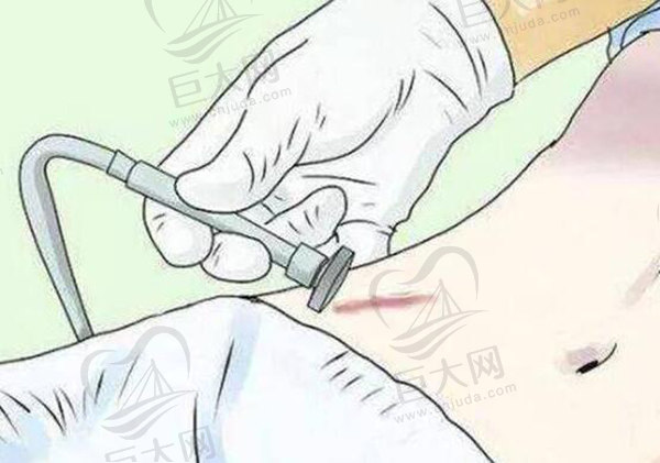 疤痕治疗