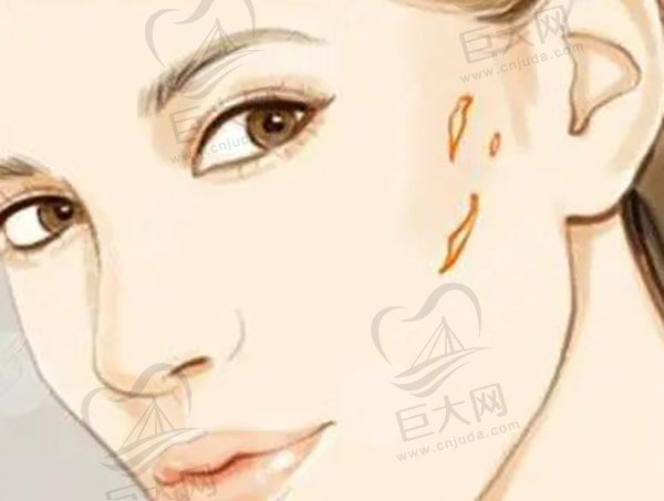 疤痕