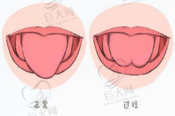 舌系带正常与过短对比图