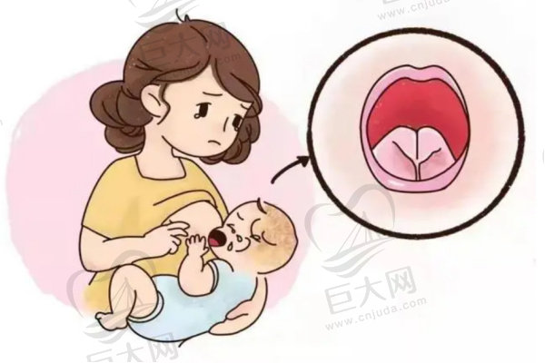 舌系带过短影响母乳喂养