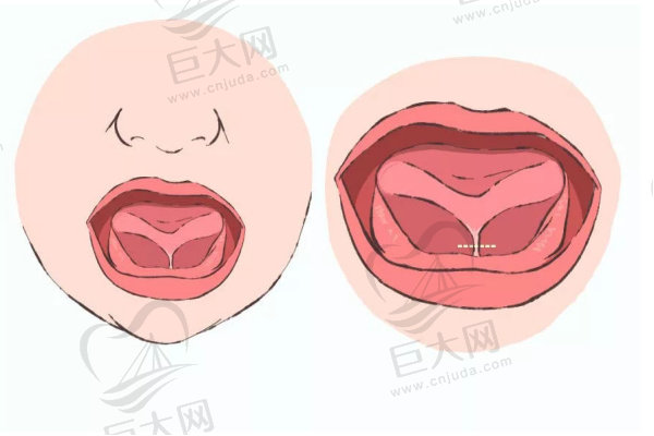 舌系带切除手术