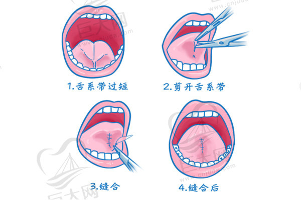舌系带切除手术流程