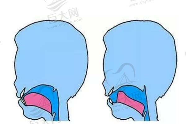 舌系带过短侧面对比图