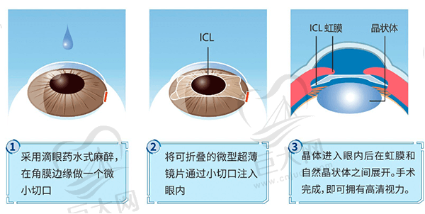 现在做近视眼手术安 全吗？近视眼手术的风险和后遗症须知