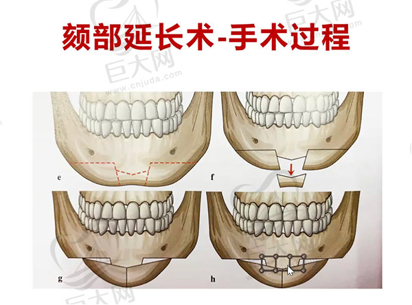 南京磨骨医生排行榜前十名：沈干