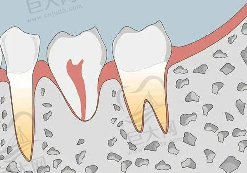 正畸牙根吸收怎么处理