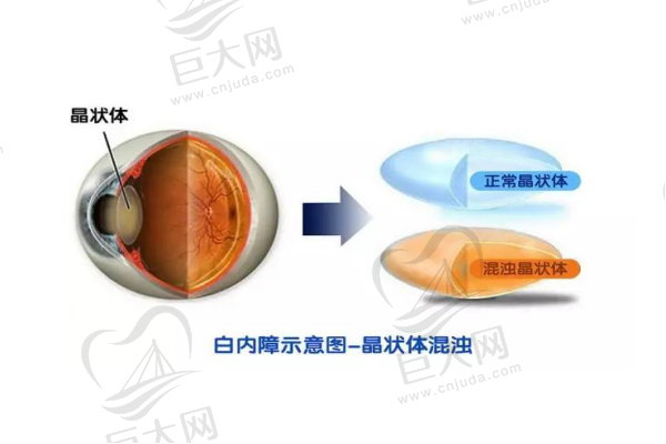 正常晶状体与白内障晶状体对比图