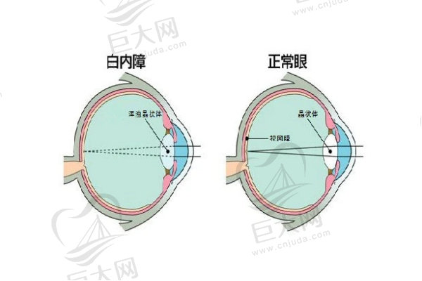 白内障内聚焦改变