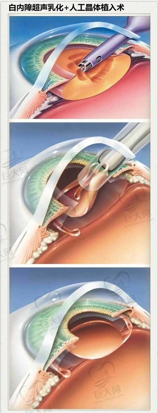 白内障早期蕞佳治疗方法超声乳化晶体植入术