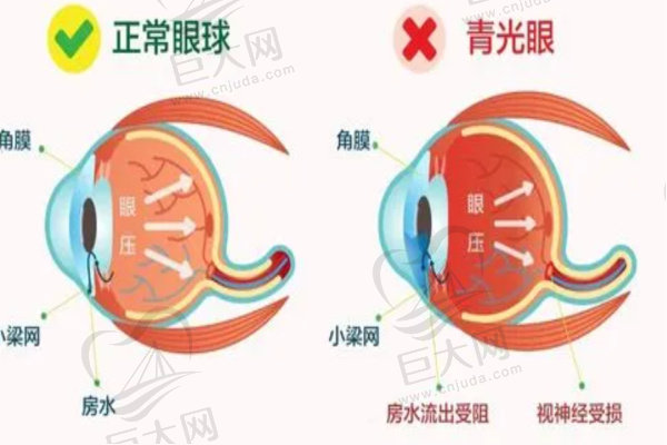 青光眼和正常眼对比图