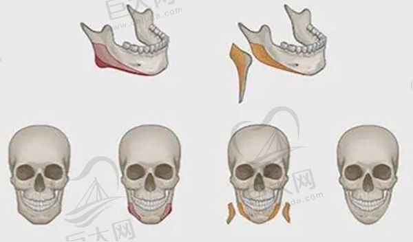 成都下颌角手术哪个医生好？李继华/罗恩/张立天等技术审美在线