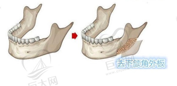 成都下颌角手术哪个医生好？李继华/罗恩/张立天等技术审美在线