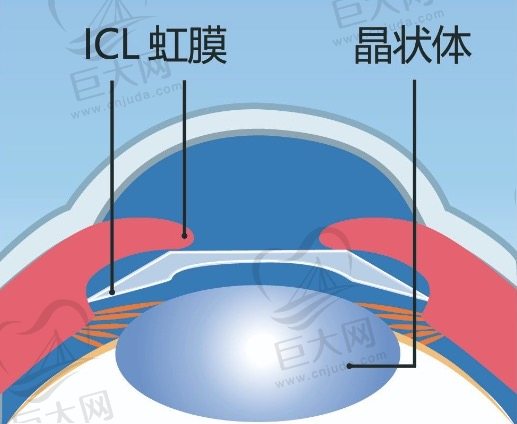 ICL晶体植入可以维持多久