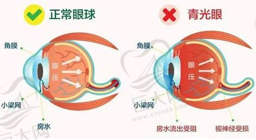 青光眼的症状和表现是什么