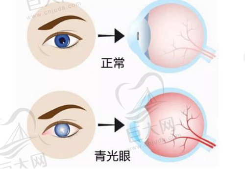 青光眼恢复的方法有哪些