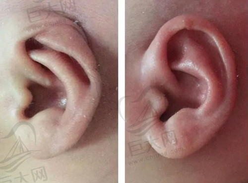 耳再造手术