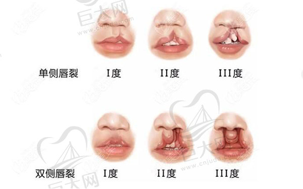 国内做唇腭裂修复医院排名