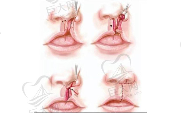 国内做唇腭裂修复医院排名+二期修复医生名单
