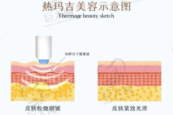 热玛吉点阵原理