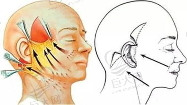 杜太超拉皮面诊设计方案