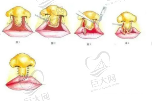 双侧复杂兔唇修复手术