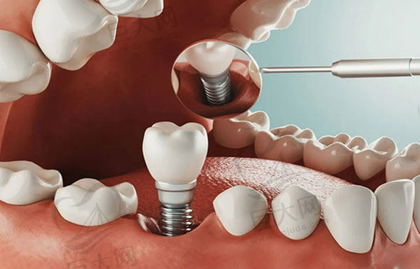 上海尤旦口腔医院种植牙多少钱