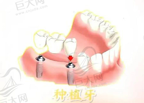 上海镶牙齿多少钱一颗