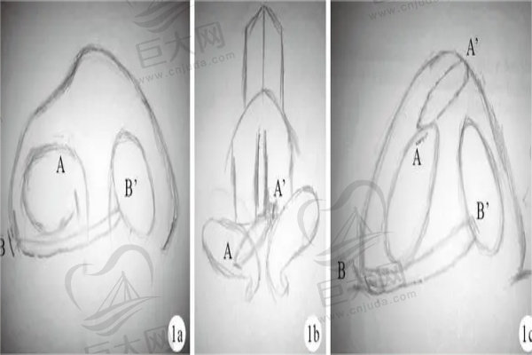 唇腭裂鼻子他想的形态草图
